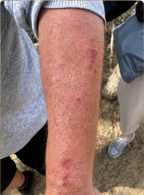 Week 1 before H2 Shower showing visible eczema, dryness and redness