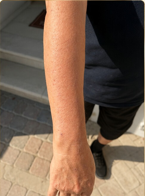 Week 5 after H2 Shower showing visibly calmer and clearer-looking skin